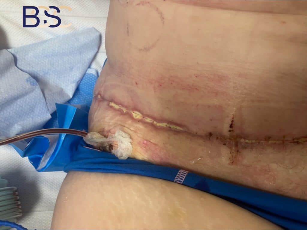 wound breakdown post surgery