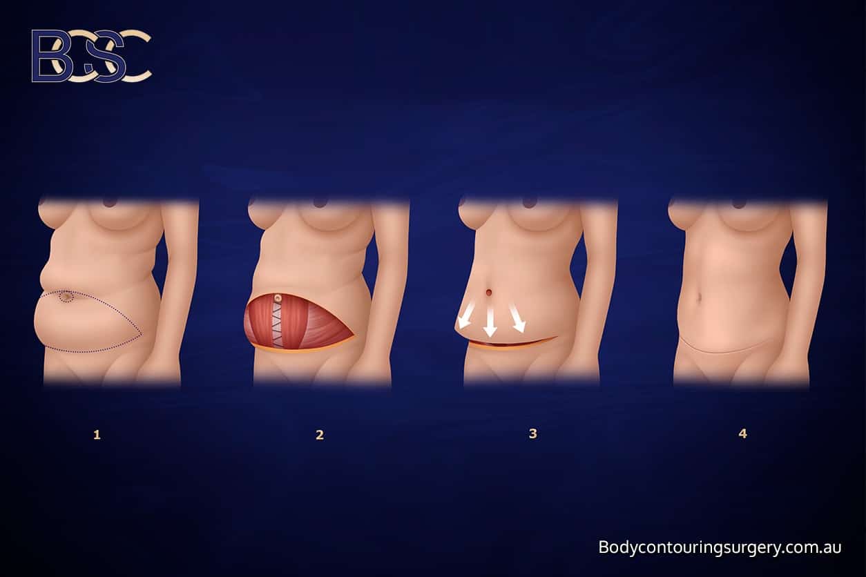 Abdominoplasty - Body Contouring Surgery Clinic Abdominoplasty