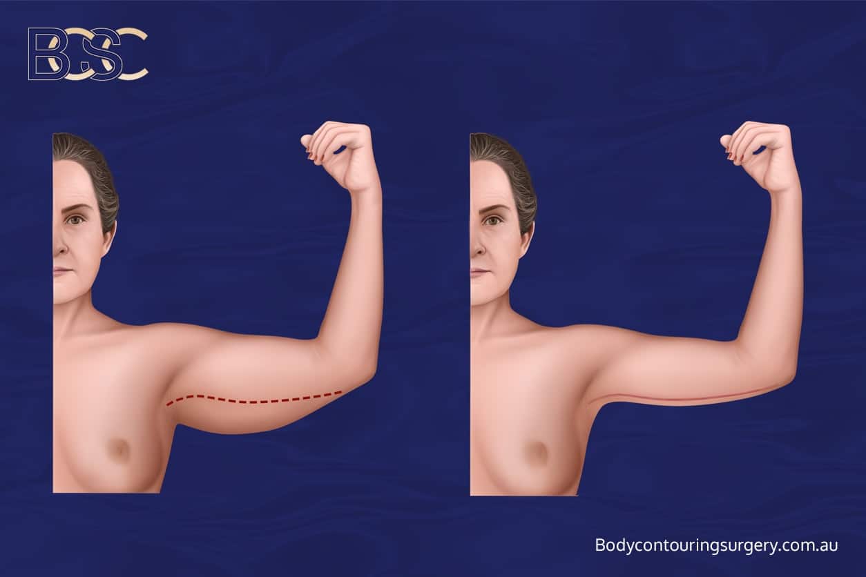 Brachioplasty - Body Contouring Surgery Clinic Brachioplasty