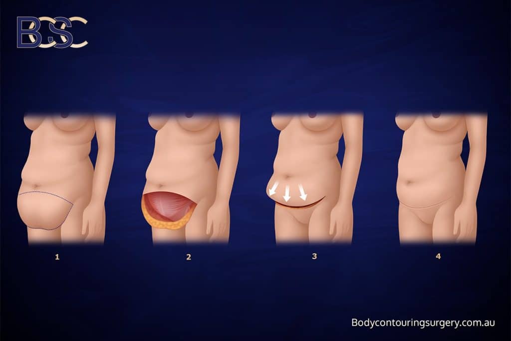 Abdominal lipectomy or apronectomy