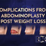 Overview of Abdominoplasty After Weight Loss