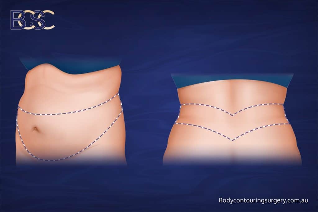 Belt Lipectomy / Lower Body Lift