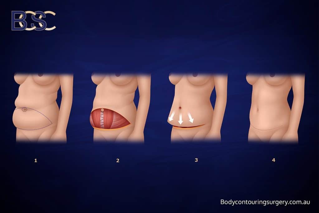 Body Contouring Surgery Clinic - Abdominoplasty