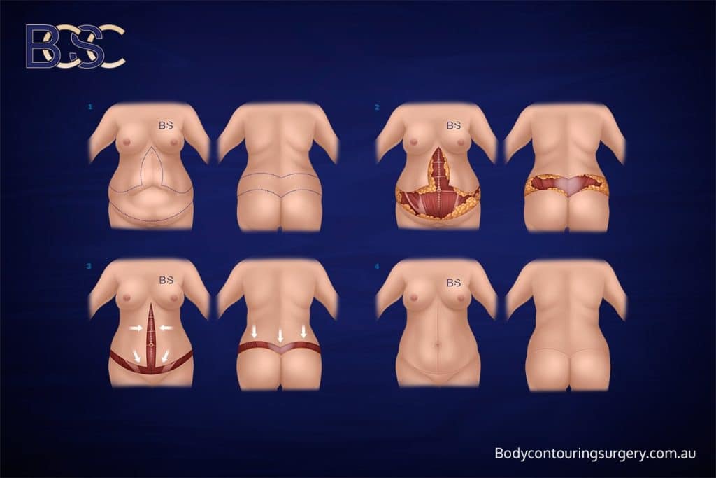 Body Contouring Surgery Clinic - Anterior Vertical Excision + Circumferential Lipectomy