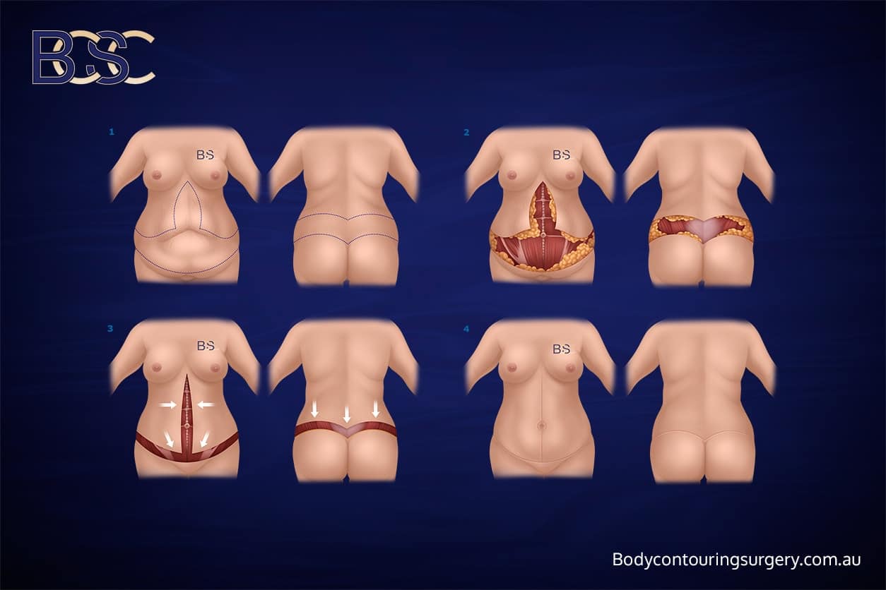 Body Contouring Surgery Clinic - Anterior Vertical Excision + Circumferential Lipectomy