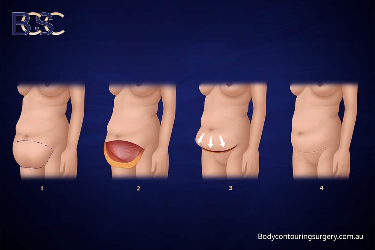 Body Contouring Surgery Clinic - Apronectomy