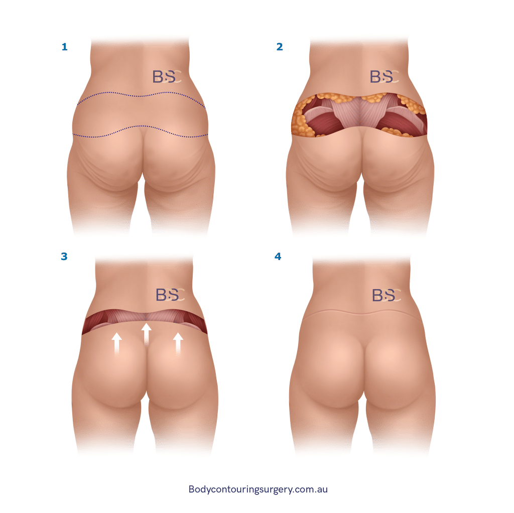 Body Contouring Surgery Clinic - Back Lipectomy