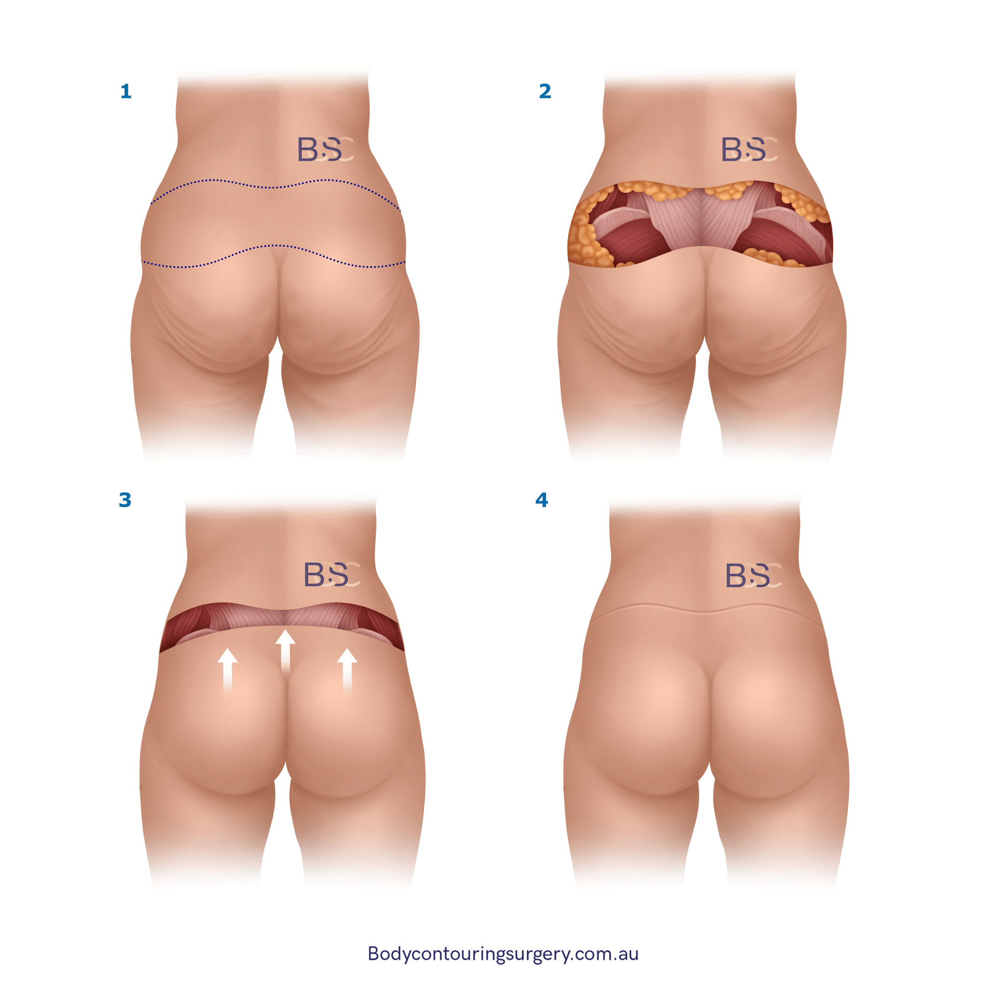 Body Contouring Surgery Clinic - Back Lipectomy