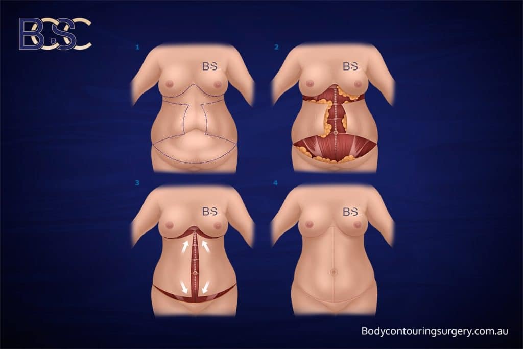 Body Contouring Surgery Clinic - Fleur-de-Lis Abdominoplasty + Upper Abdominal Lipectomy