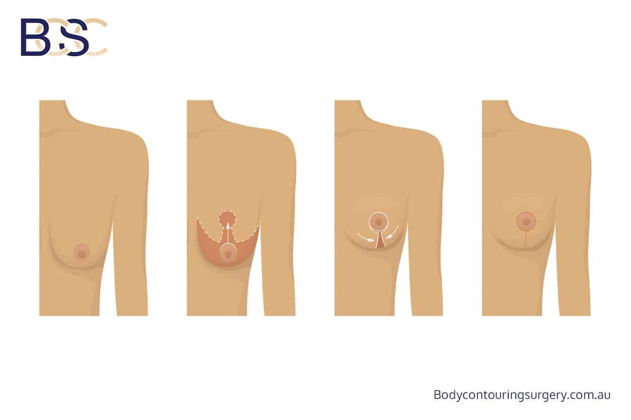 Body Contouring Surgery Clinic - Mastopexy (Breast Surgery)