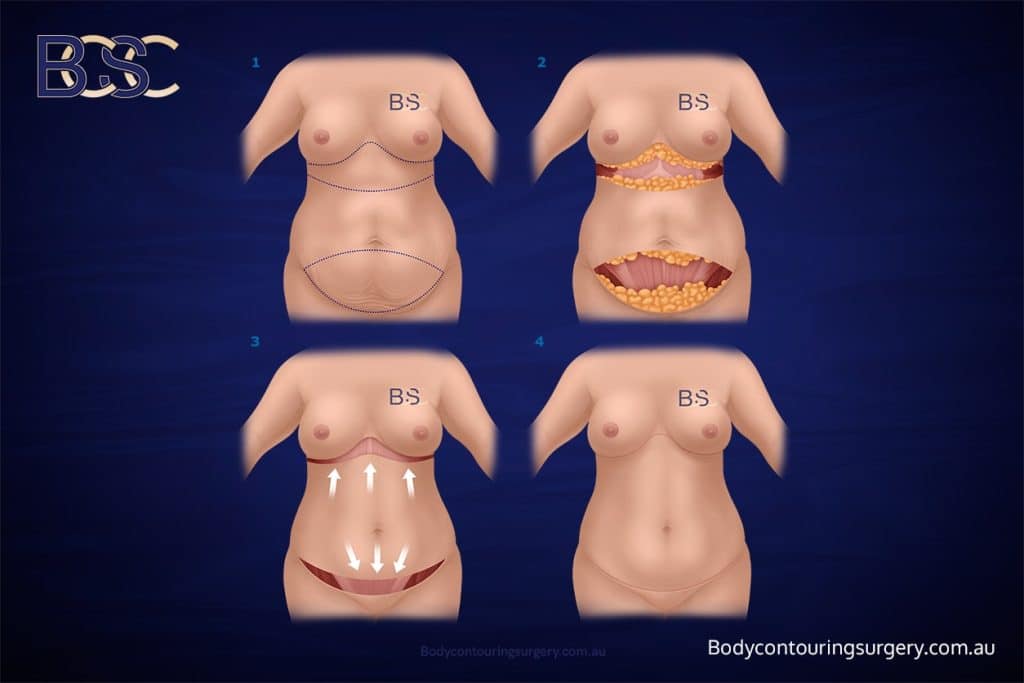 Body Contouring Surgery Clinic - Upper + Lower Abdominal Lipectomy