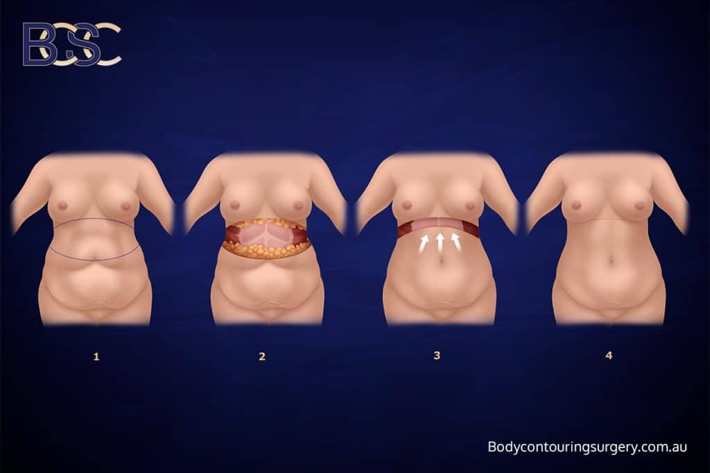 Body Contouring Surgery Clinic - Upper Trunk Lipectomy (Upper Body Lift)