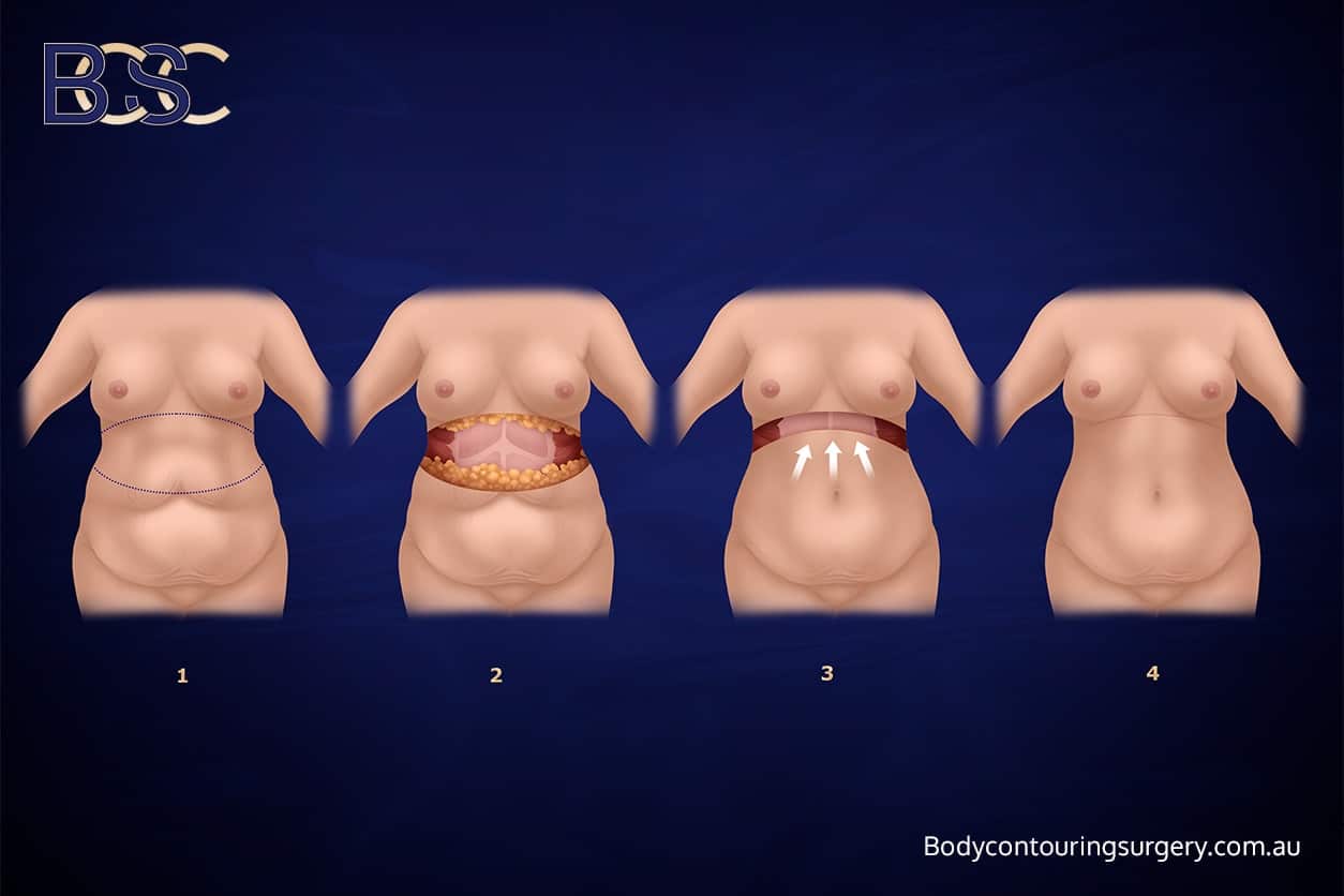 Body Contouring Surgery Clinic - Upper Trunk Lipectomy (Upper Body Lift)