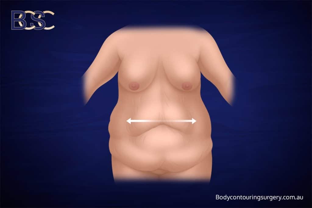 Excess Skin Appears After Weight Loss