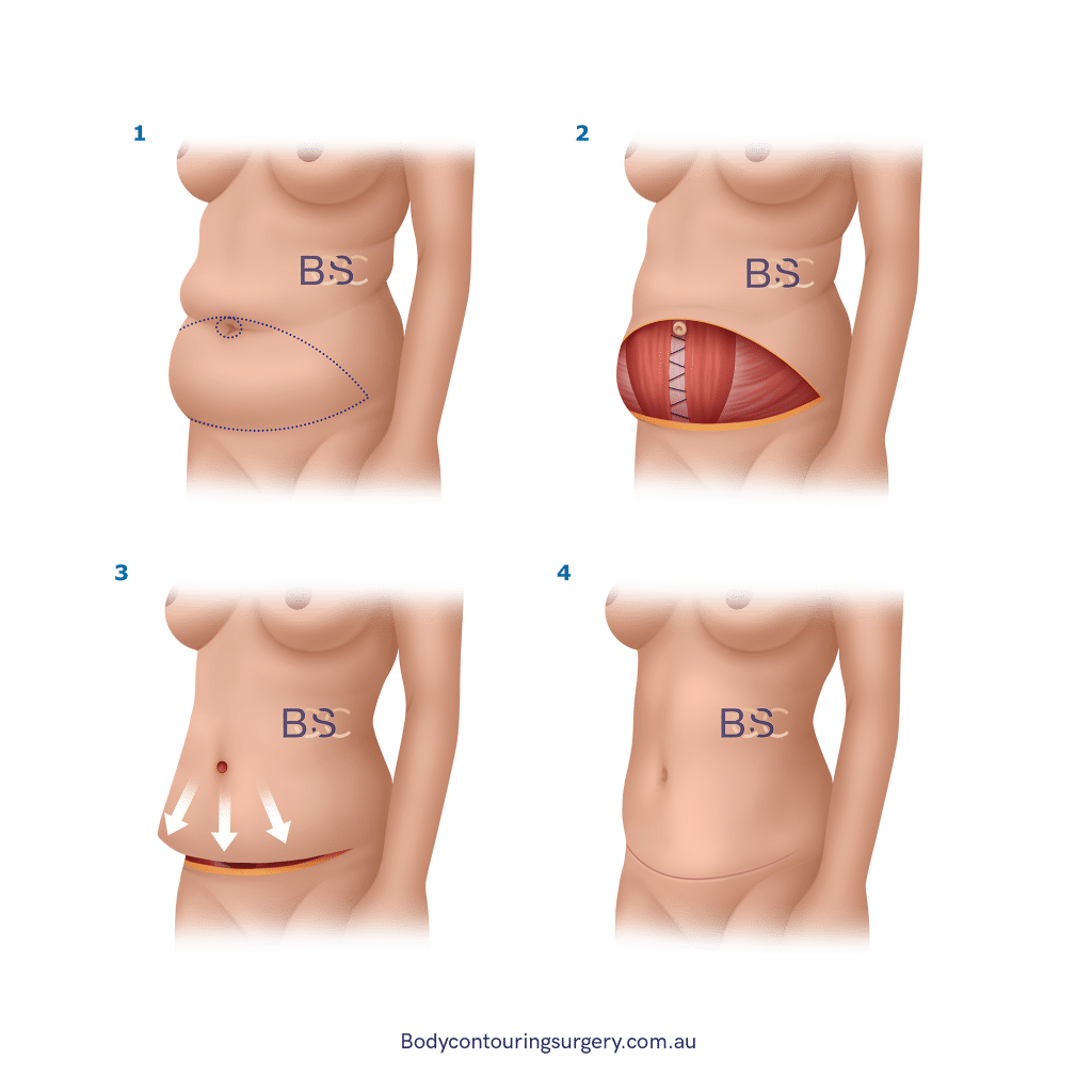 Full Abdominoplasty - BCSC
