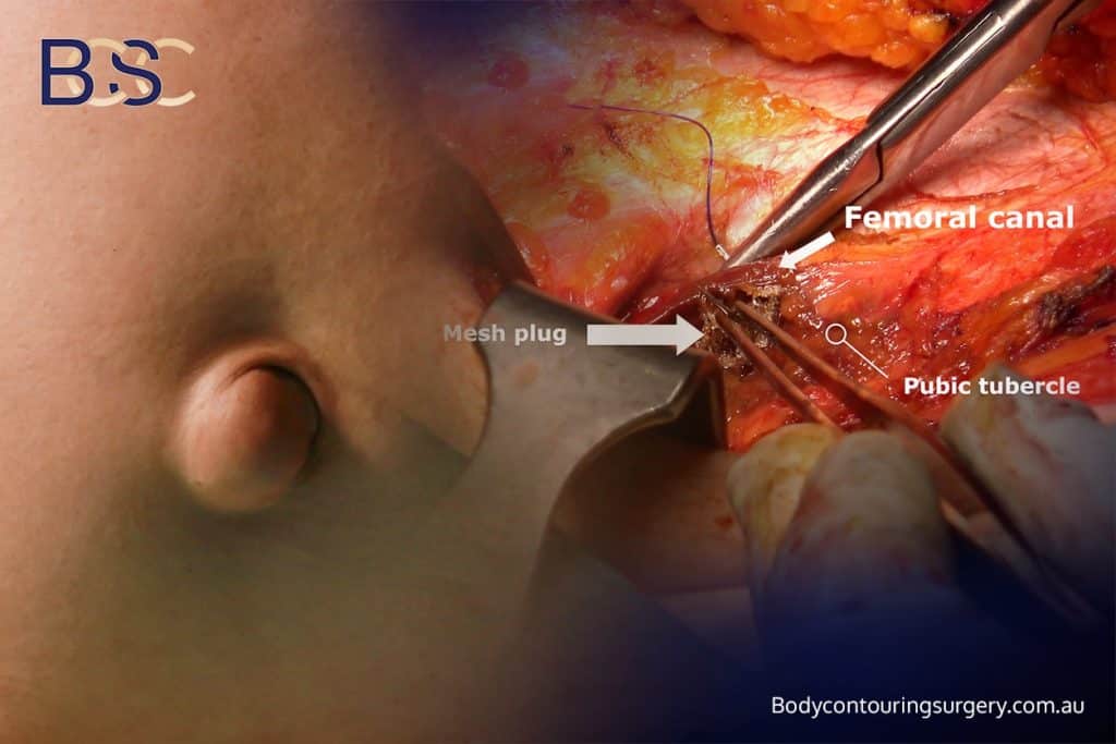 Hernia Repair with Abdominoplasty