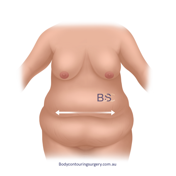 Horizontal excess skin - Abdominoplasty