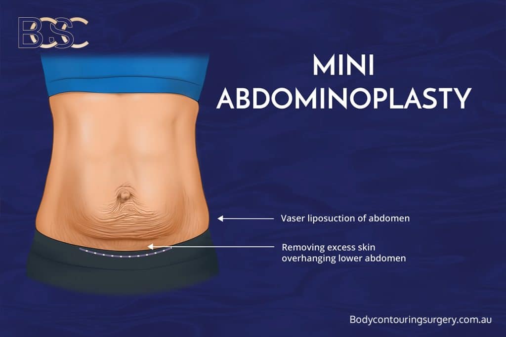 Limited Abdominoplasty (Mini Abdominoplasty)