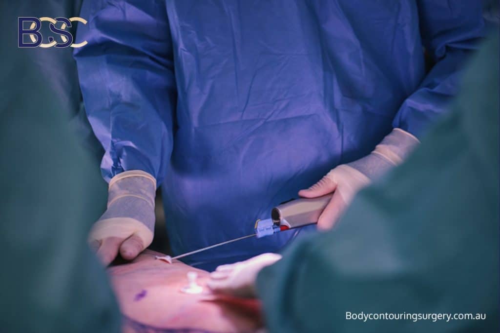 Liposuction with Abdominoplasty