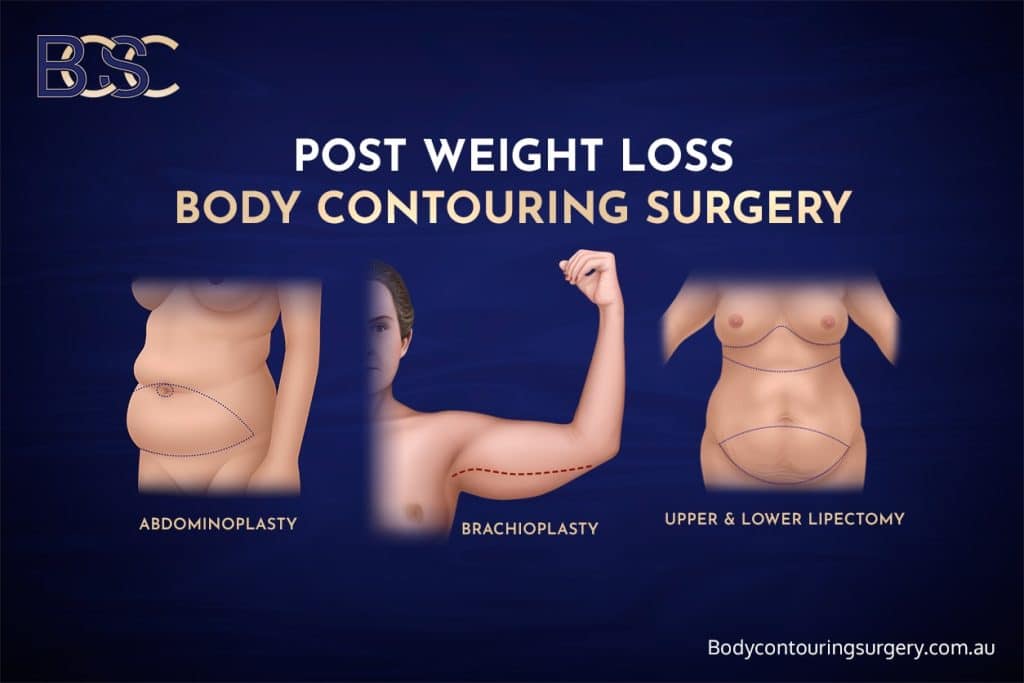 Post Weight Loss Body Contouring Surgery