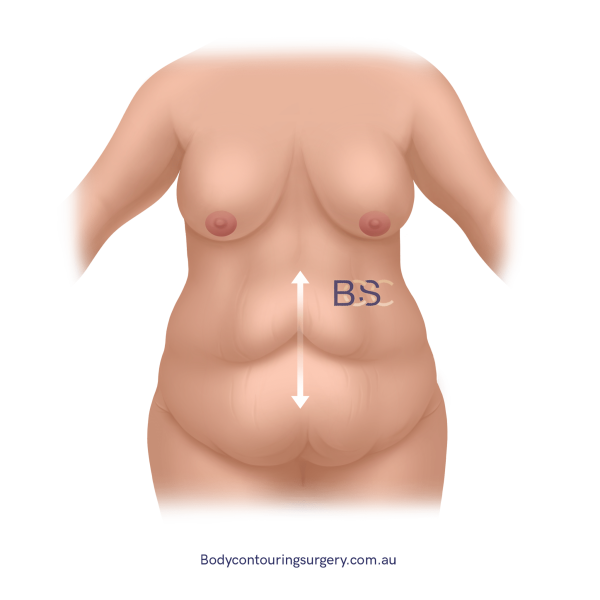 Vertical Excess Skin - Abdominoplasty