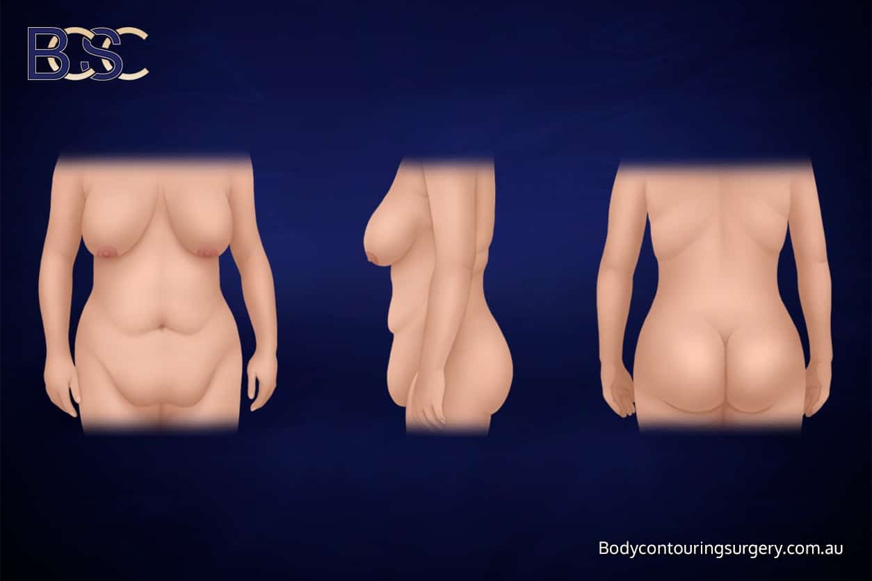 Post weight loss patient with loose skin Post weight loss patient with loose skin