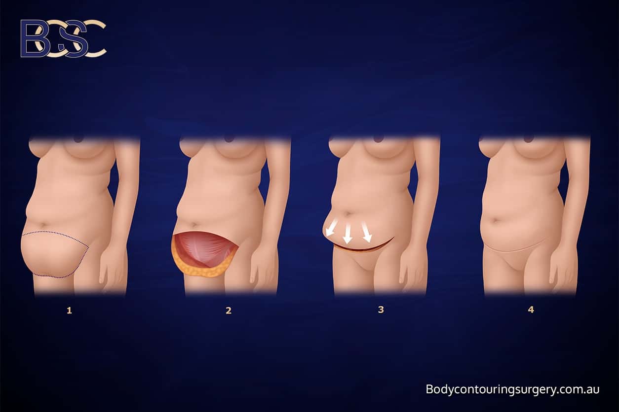 Apronectomy - Body Contouring Surgery Clinic Apronectomy