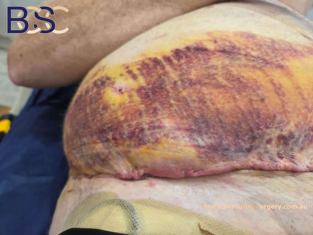 haematoma post surgery