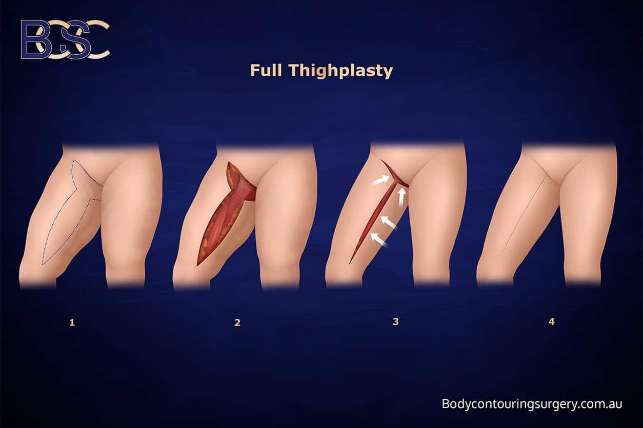 Inner Thighplasty - Body Contouring Surgery Clinic Inner Thighplasty