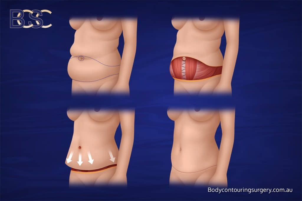 Circumferential lipectomy