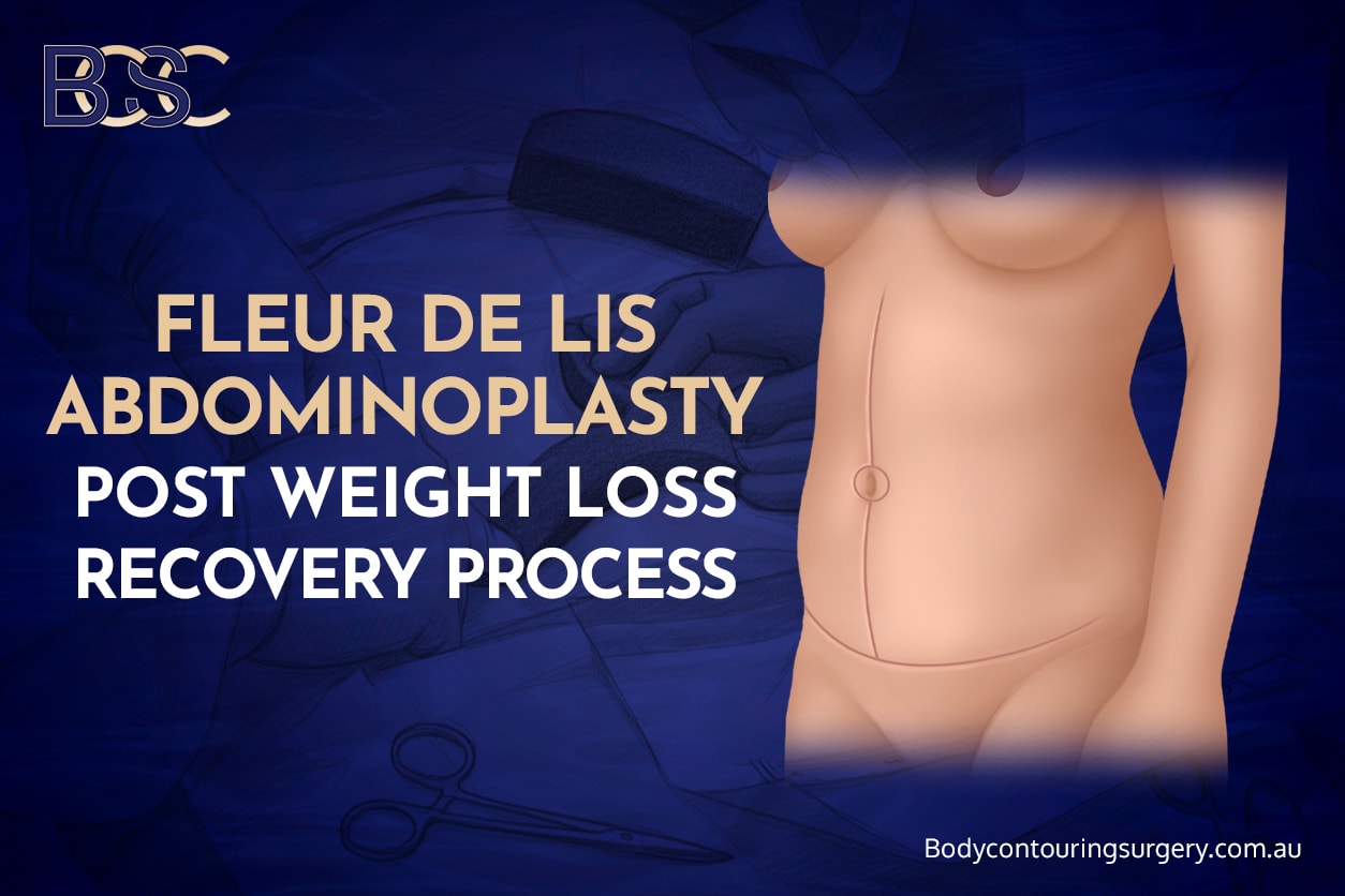 Fleur de lis abdominoplasty