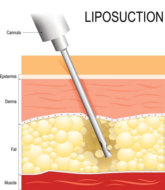 Liposuction