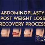 Abdominoplasty Post Weight Loss Recovery Process (Standard and Extended Abdominoplasty)