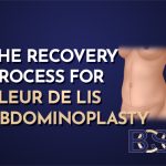 The Recovery Process for Fleur-de-Lis Abdominoplasty Post-Weight Loss