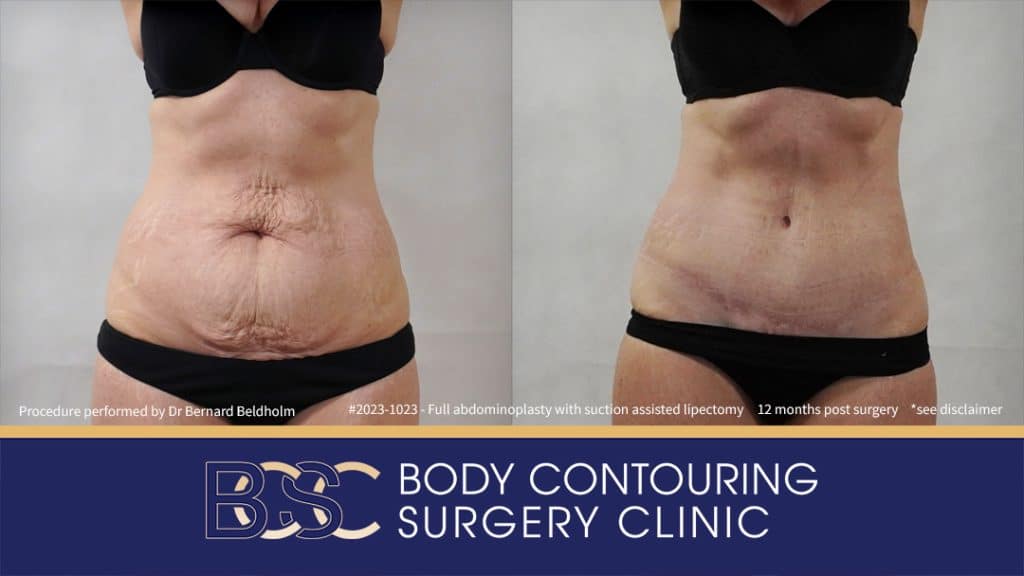 Patient 2023-1023 Full Abdominoplasty Post Pregnancy: Repair Femoral Hernia & Diastasis Recti - Front