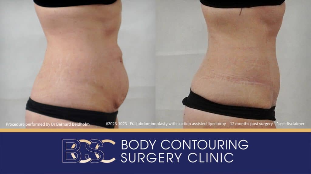 Patient 2023-1023 Full Abdominoplasty Post Pregnancy: Repair Femoral Hernia & Diastasis Recti - Left Side