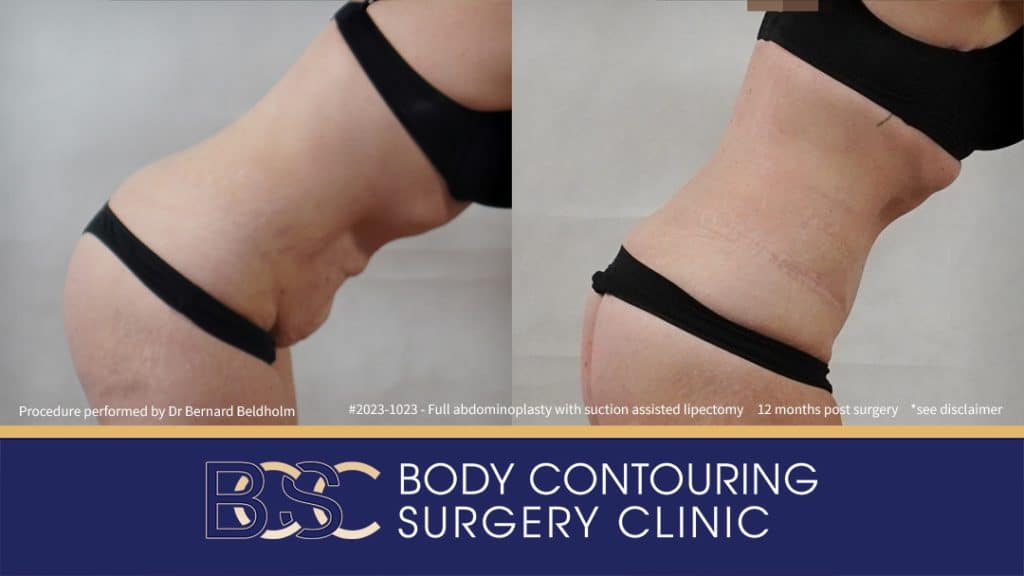 Patient 2023-1023 Full Abdominoplasty Post Pregnancy: Repair Femoral Hernia & Diastasis Recti - Left Bend