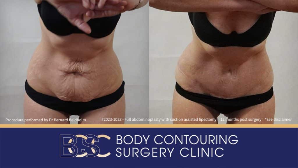 Patient 2023-1023 Full Abdominoplasty Post Pregnancy: Repair Femoral Hernia & Diastasis Recti - Front Bend