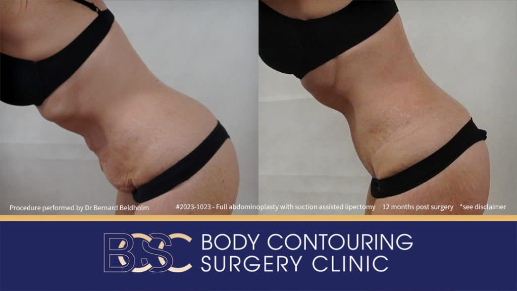 Patient 2023-1023 Full Abdominoplasty Post Pregnancy: Repair Femoral Hernia & Diastasis Recti - Right Bend