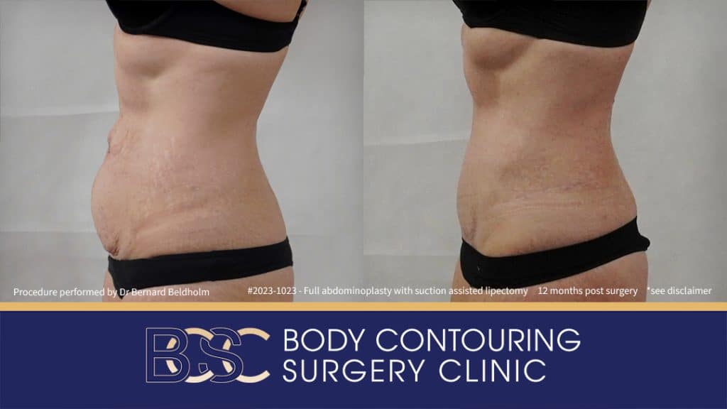 Patient 2023-1023 Full Abdominoplasty Post Pregnancy: Repair Femoral Hernia & Diastasis Recti - Right Side