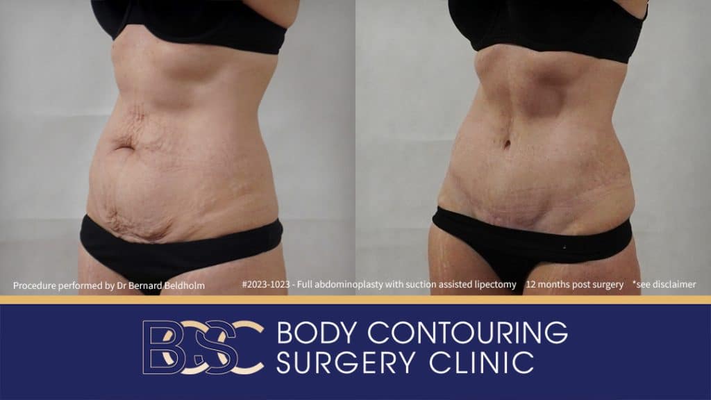 Patient 2023-1023 Full Abdominoplasty Post Pregnancy: Repair Femoral Hernia & Diastasis Recti - Right
