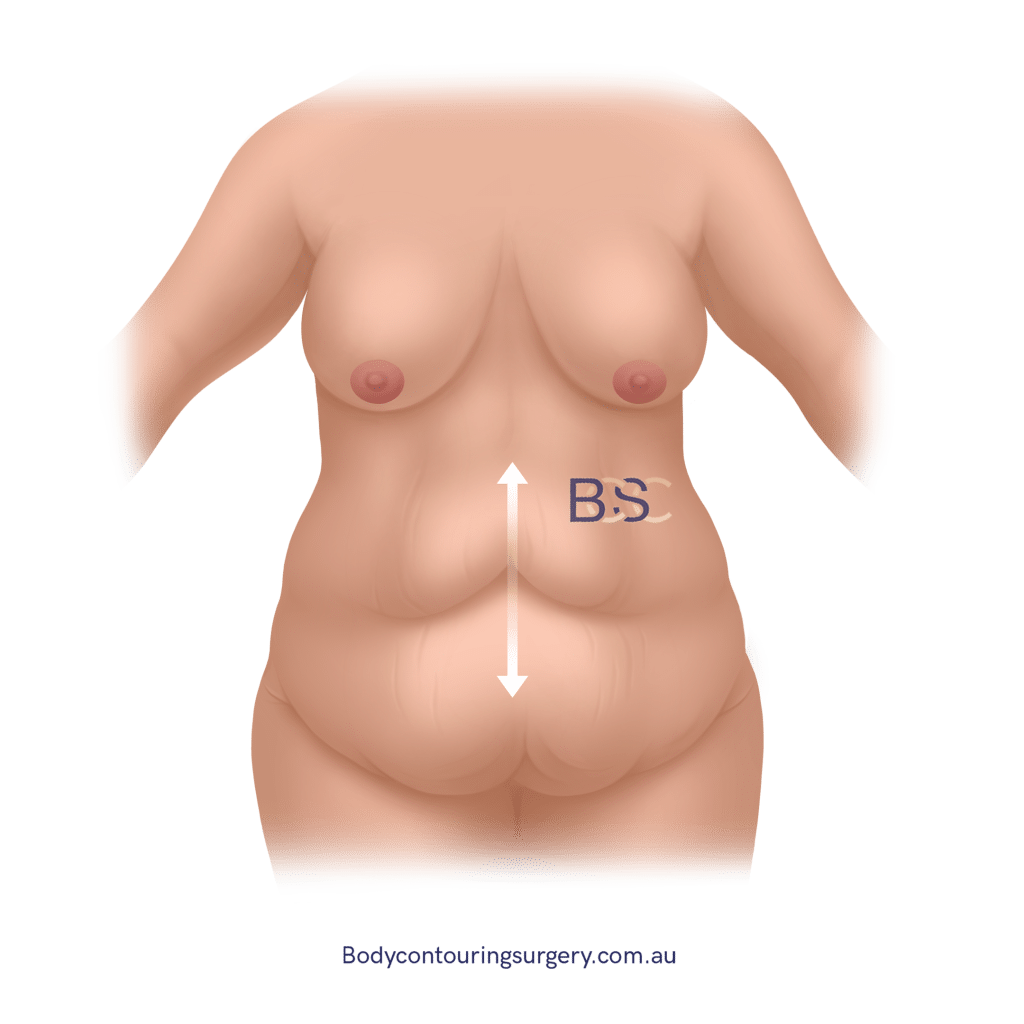 Excess vertical skin