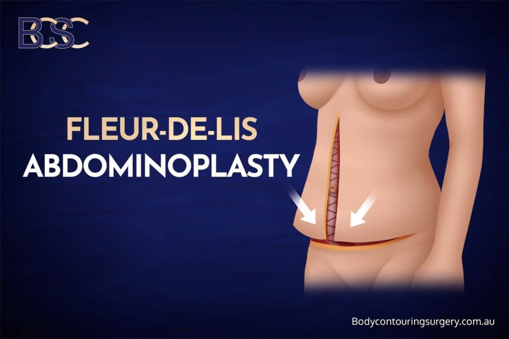 Fleur de lis abdominoplasty - BCSC
