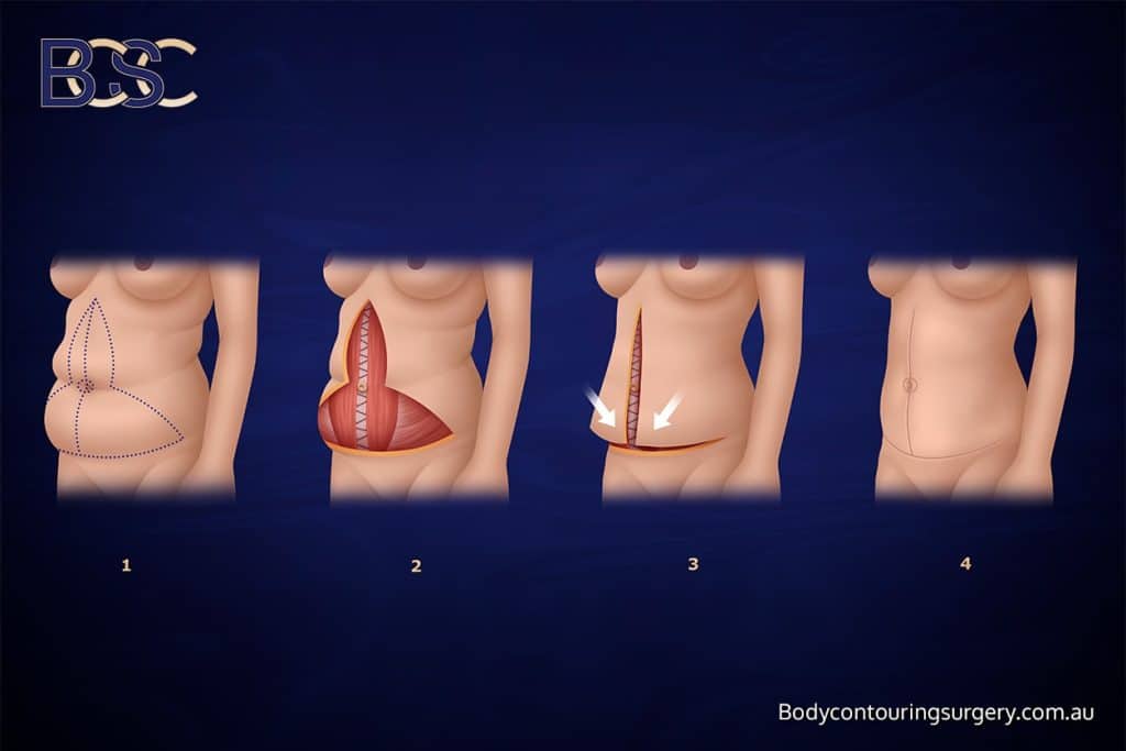 Fleur de lis abdominoplasty operation steps | BCSC