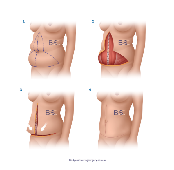 Fleur de lis abdominoplasty post weight loss