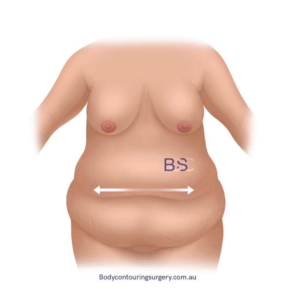 Horizontal excess skin post weight loss