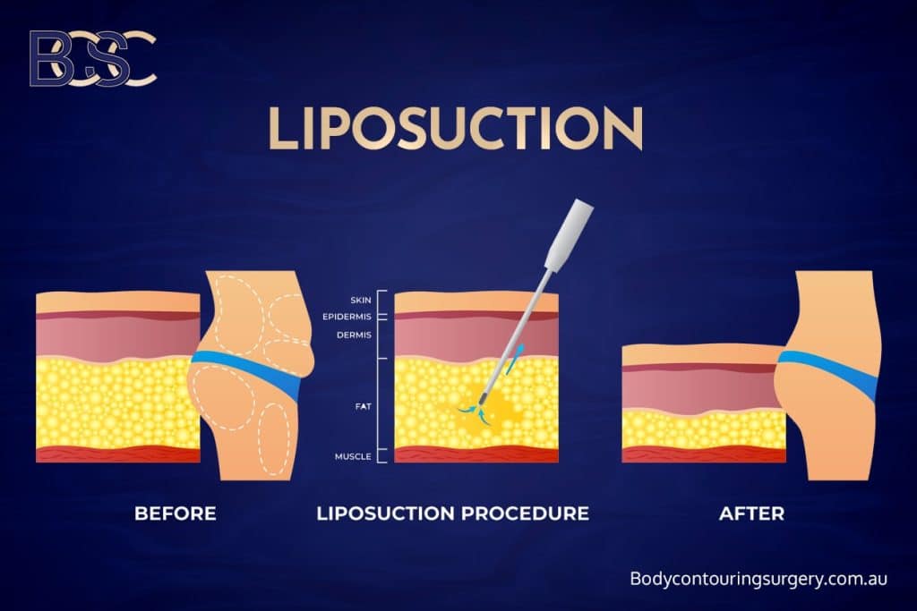 Suction-Assisted Lipectomy (VASER Liposuction)