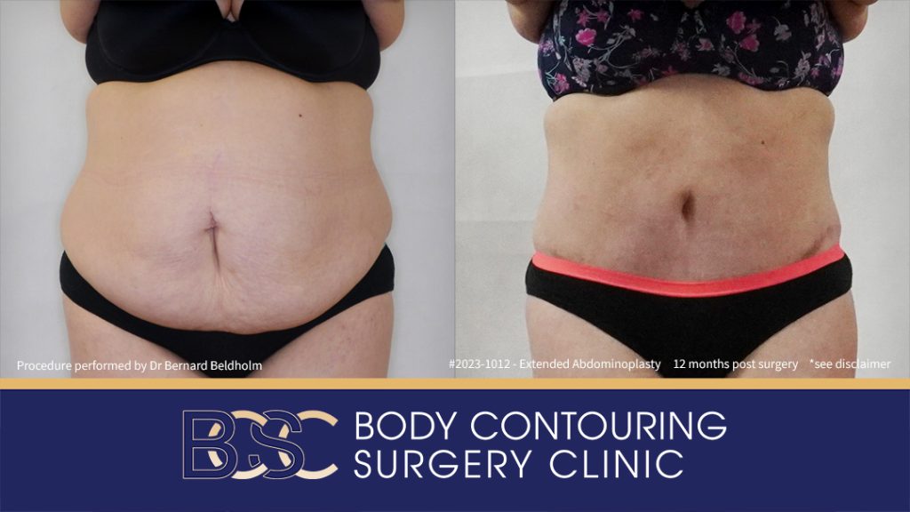 Abdominoplasty Post Weight Loss and Post Pregnancy, Including Repair of Diastasis Recti and VASER liposuction (Patient 2023-1012) - Front