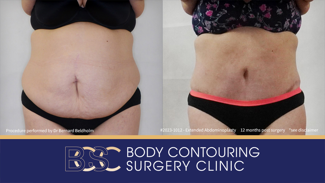 Abdominoplasty Post Weight Loss and Post Pregnancy, Including Repair of Diastasis Recti and VASER liposuction (Patient 2023-1012) - Front