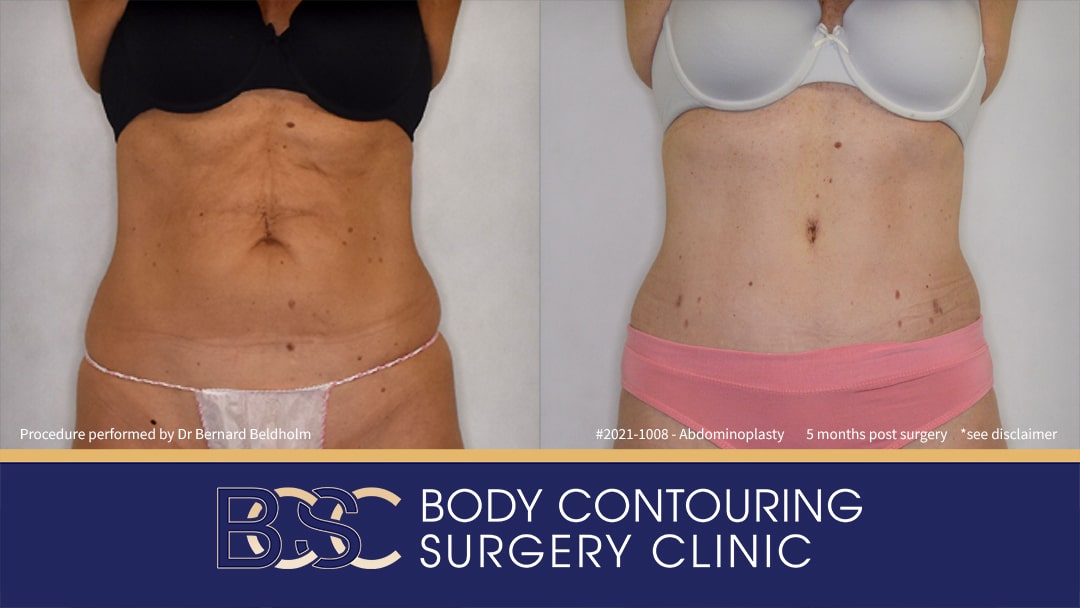 Abdominoplasty Post Weight Loss Patient 2021-1008